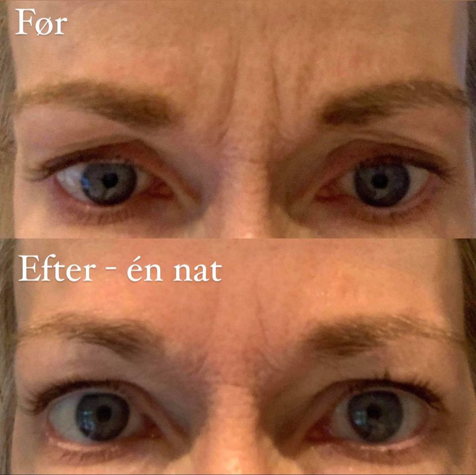 Frownies Facial Patches Trekanter (Rynkeplaster til panden)