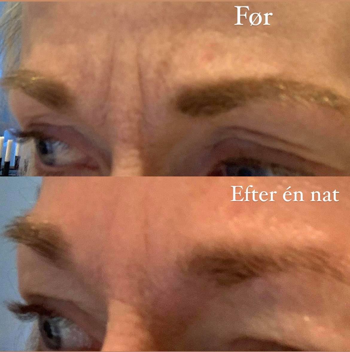Frownies Facial Patches Trekanter (Rynkeplaster til panden)